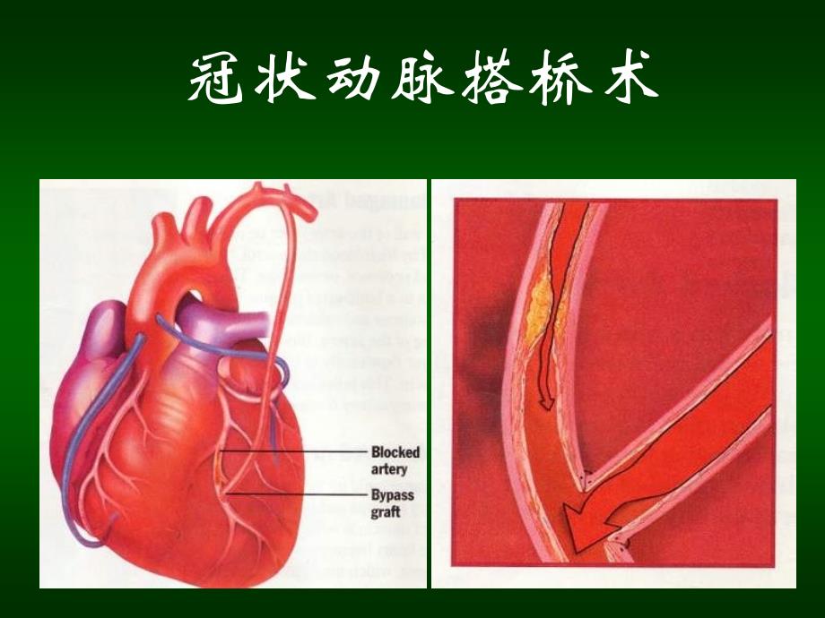 冠心病外科的进展.ppt_第4页