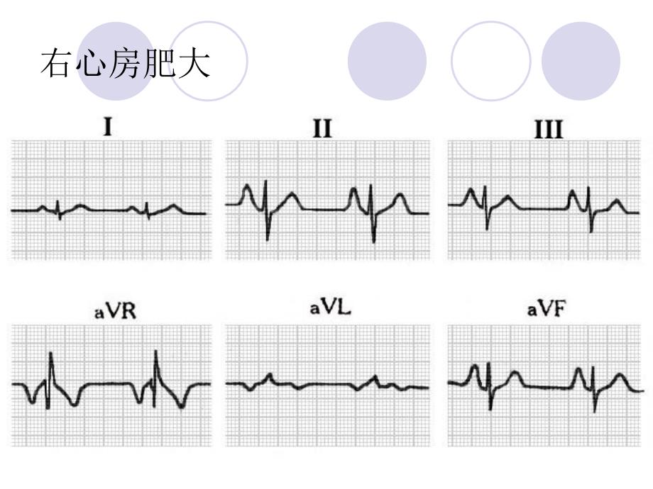 心房+、心室肥大课件_第3页