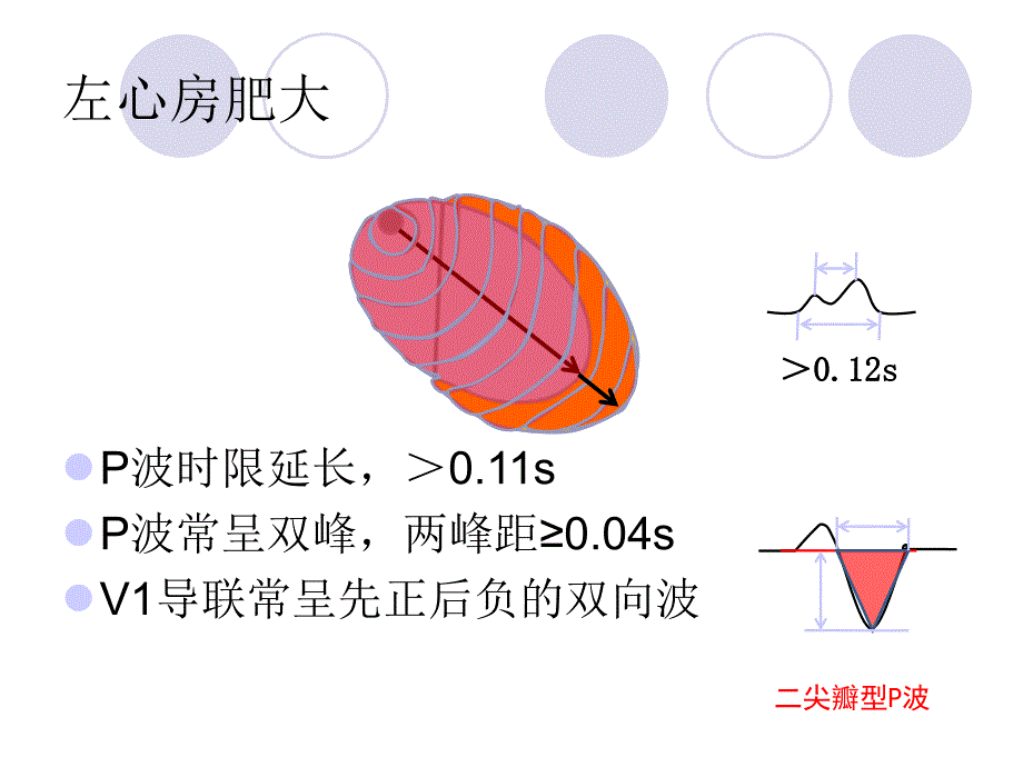 心房+、心室肥大课件_第4页