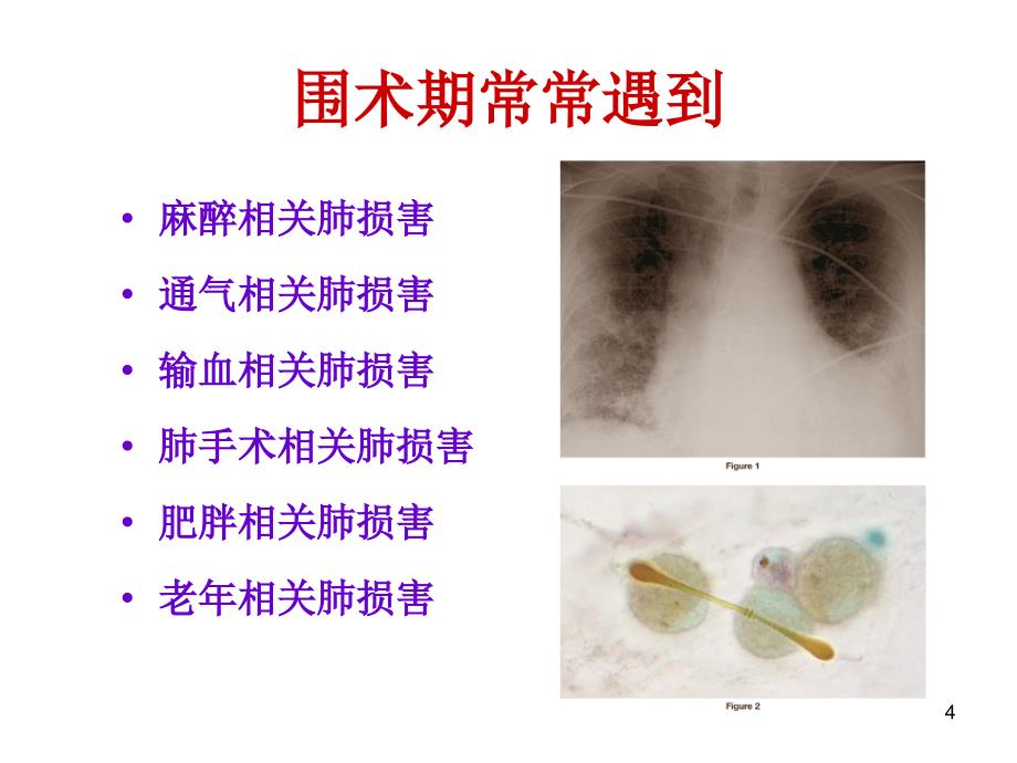 围术期肺损害与肺功能保护_第4页