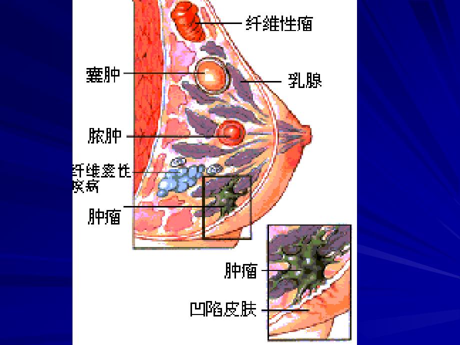 医学课件：乳腺肿瘤_第2页