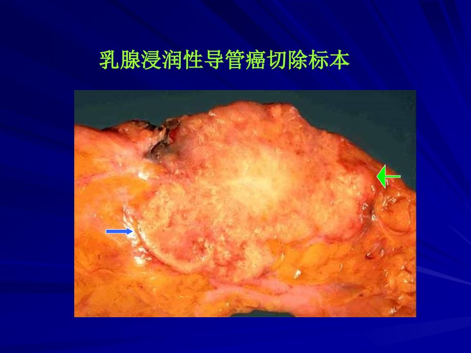 医学课件：乳腺肿瘤_第3页