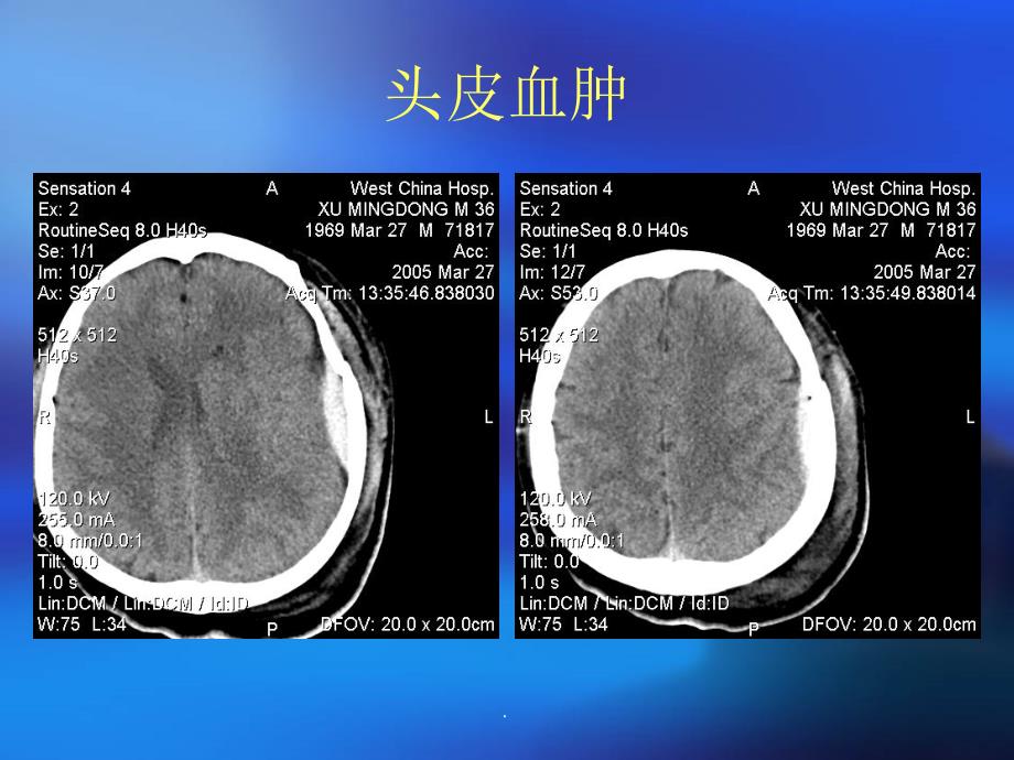 颅脑外伤及脑出血脑梗塞ppt课件_第4页