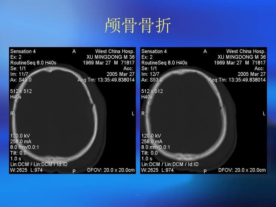 颅脑外伤及脑出血脑梗塞ppt课件_第5页