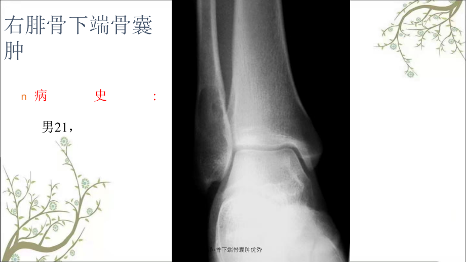 右腓骨下端骨囊肿优秀_第1页