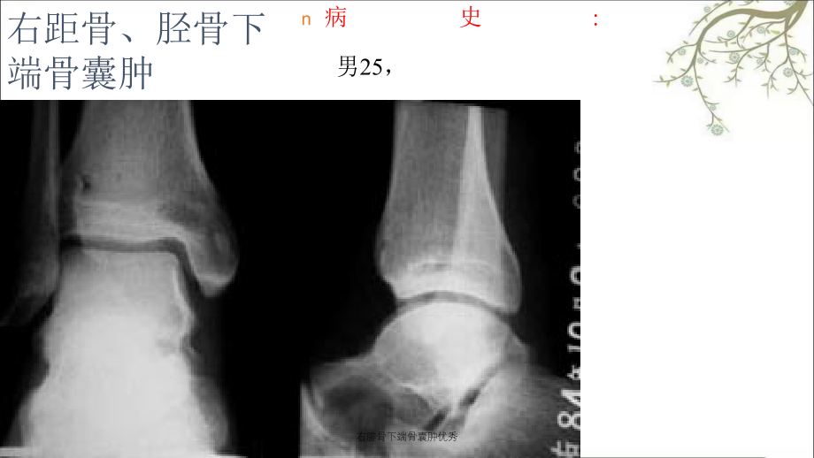 右腓骨下端骨囊肿优秀_第2页