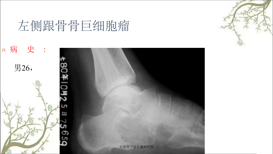 右腓骨下端骨囊肿优秀_第3页