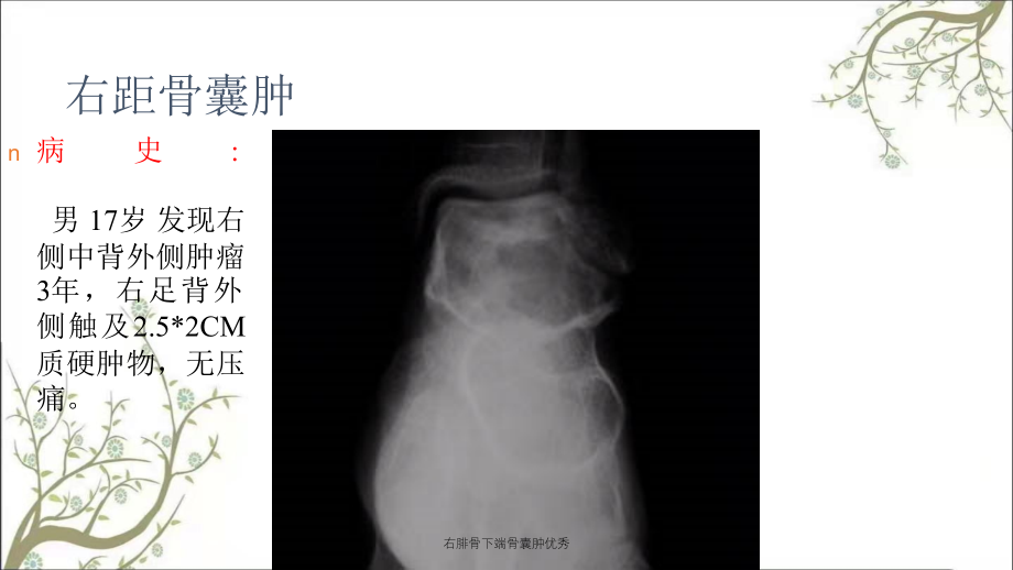 右腓骨下端骨囊肿优秀_第4页