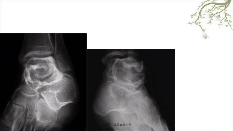 右腓骨下端骨囊肿优秀_第5页