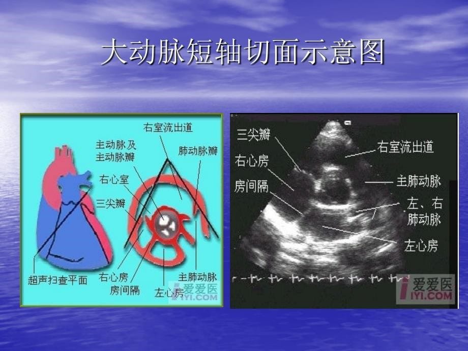 心脏超声切面示意_第5页