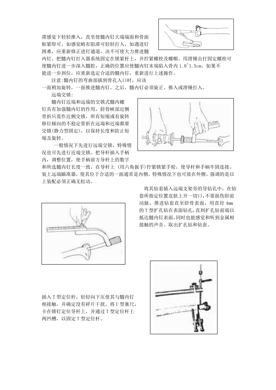 胫骨髓内钉操作使用说明_第4页