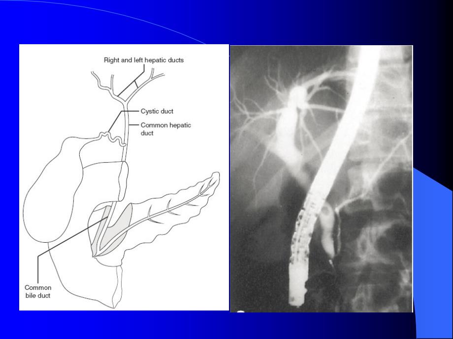 诊断性与治疗性ERCP_第3页