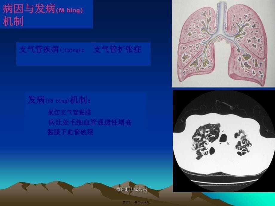 慢阻肺专家共识课件_第5页