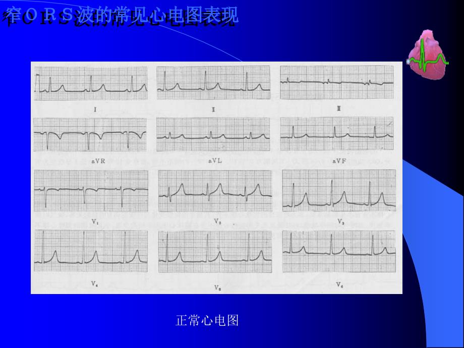 常见心电图谱_第4页