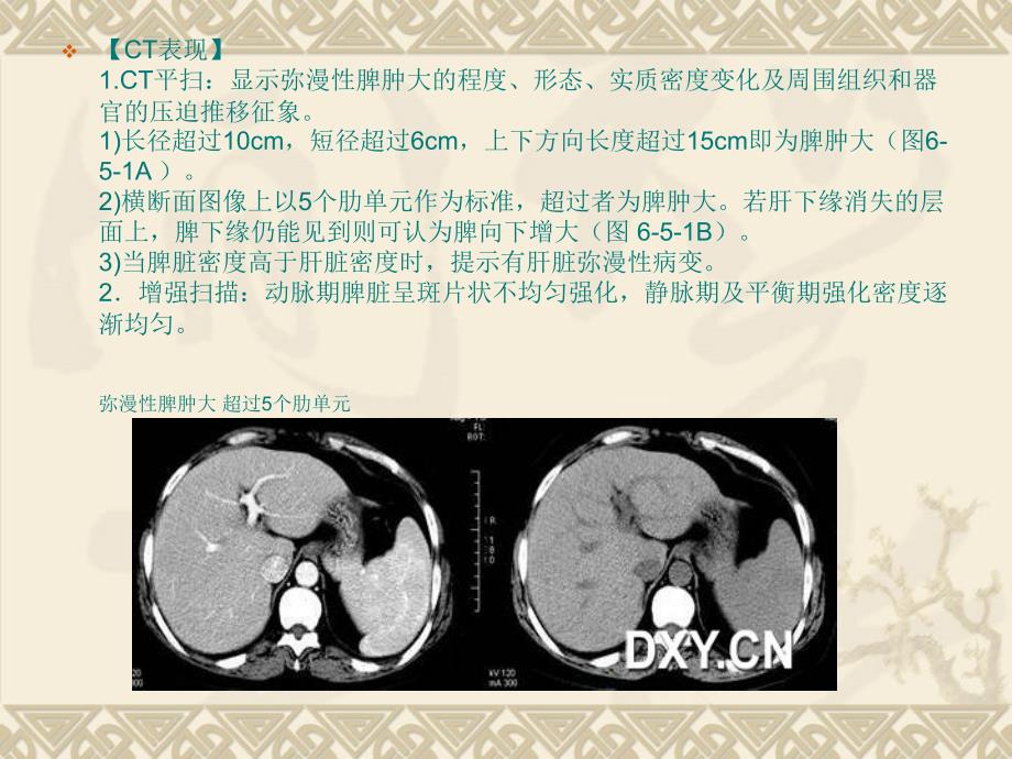 脾脏的正常与异常CT表现.ppt_第3页