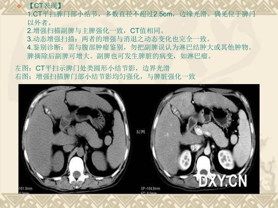 脾脏的正常与异常CT表现.ppt_第5页