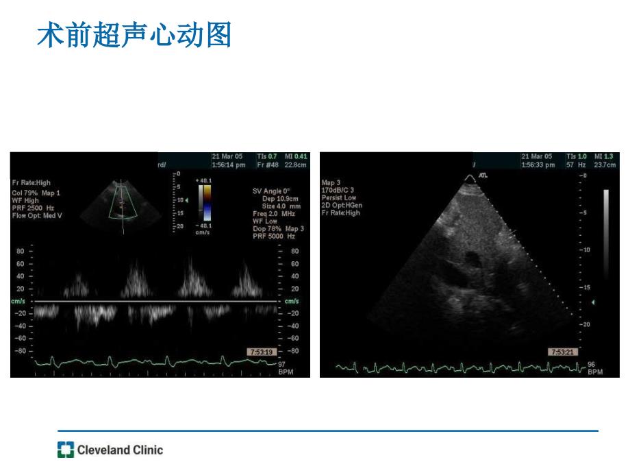 少见的瓣膜治疗三尖瓣成形课件_第4页