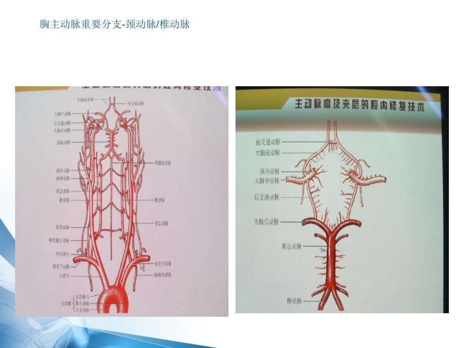 胸主动脉解剖及病理课件_第5页