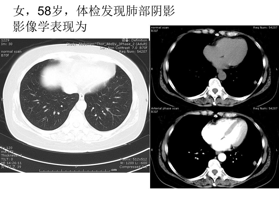 医学影像学课件：呼吸系统肿瘤及纵膈病变-答题器_第2页