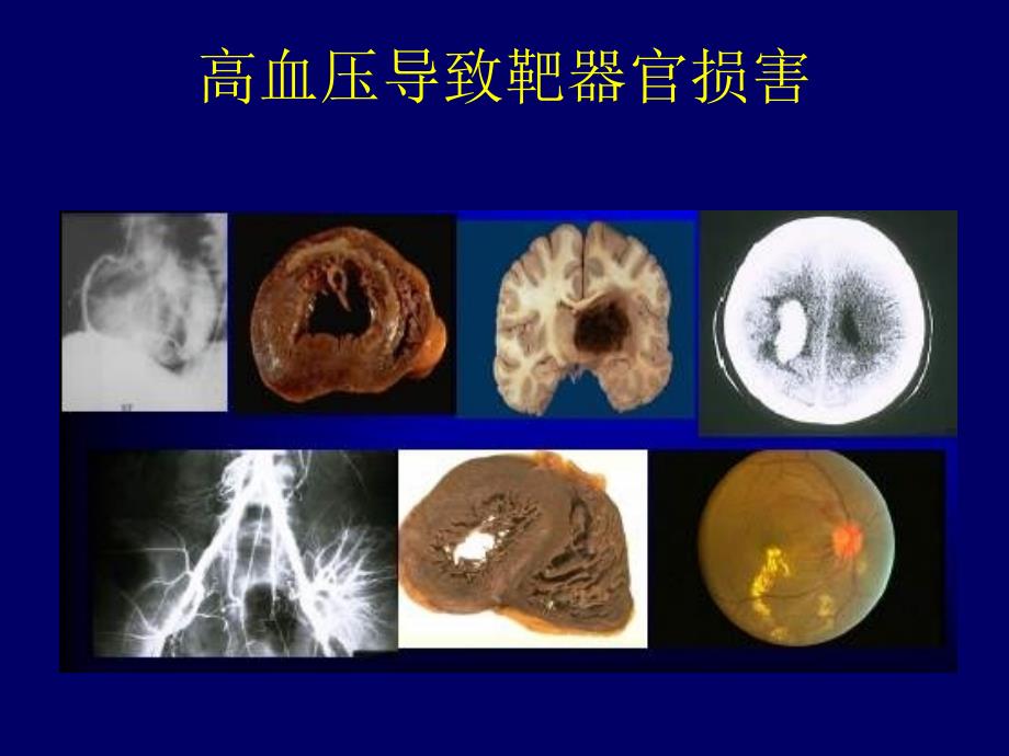 导致高血压cv风险增加的相关因素刘梅林_第2页