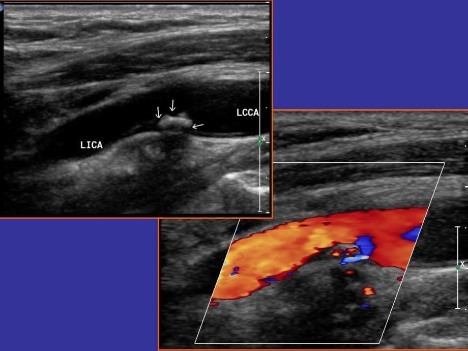 斑块的超声评价及动脉硬化性病变的鉴别_第5页