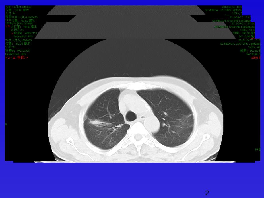 机化性肺炎ppt课件_第2页