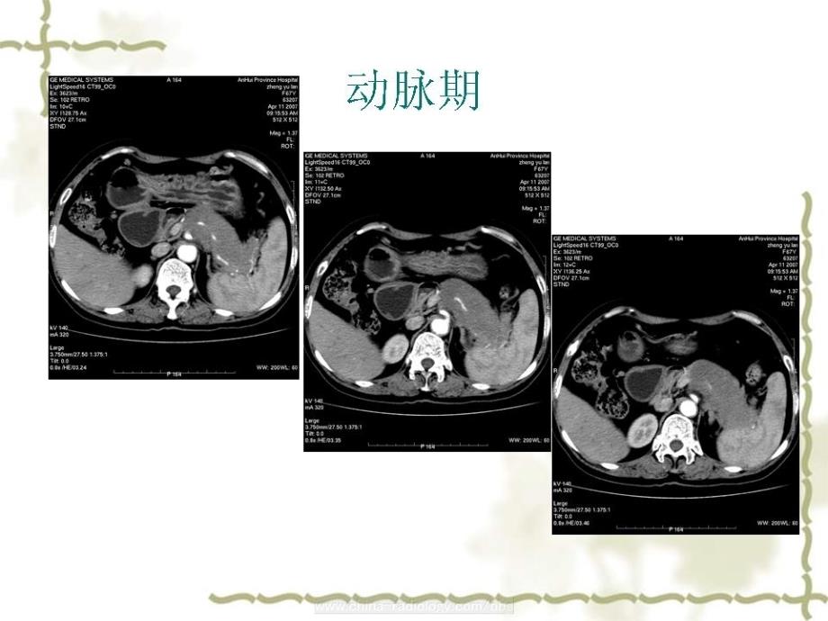 消化系统神经内分泌癌.ppt_第4页