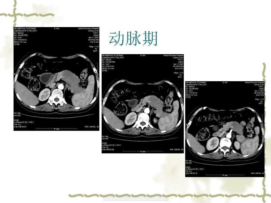 消化系统神经内分泌癌.ppt_第5页