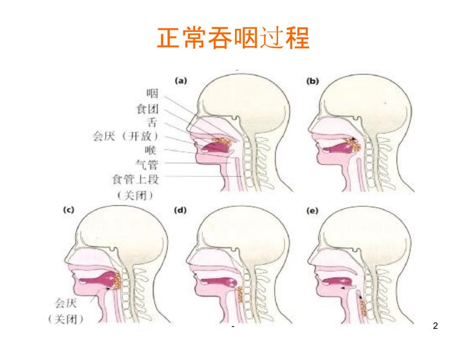 吞咽障碍护理ppt课件_第2页