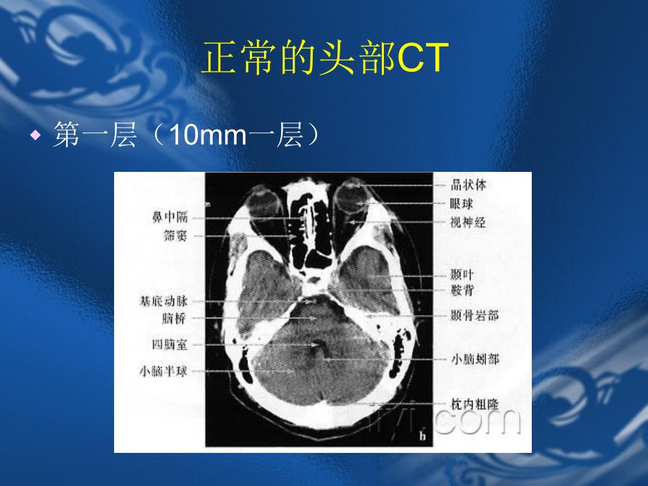 CT片的阅读技巧头部_第3页