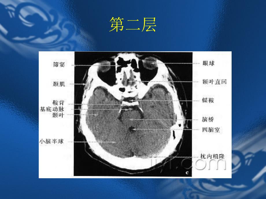 CT片的阅读技巧头部_第4页