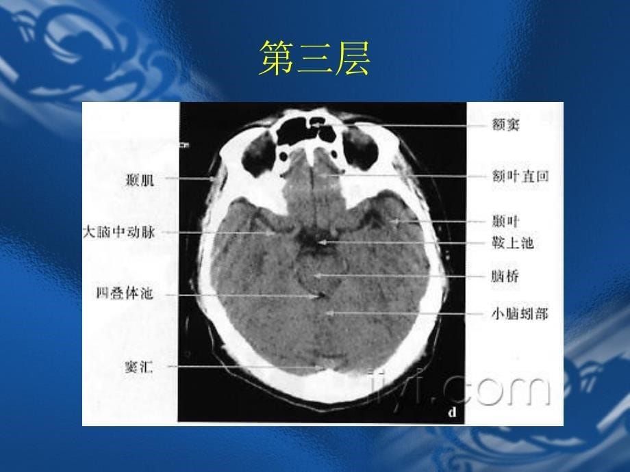 CT片的阅读技巧头部_第5页