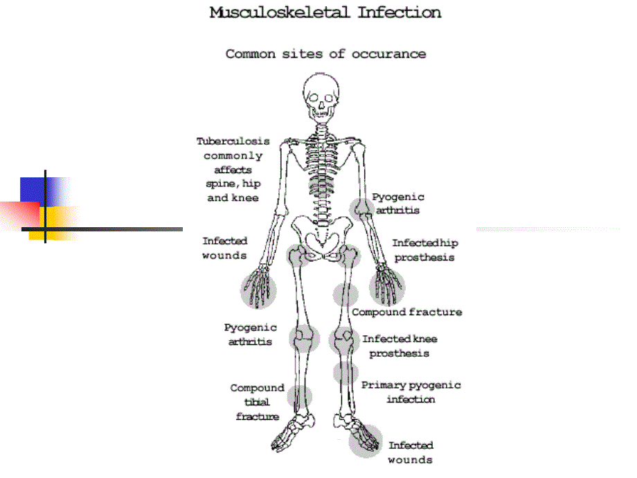 骨与关节化脓性感染课件_第2页