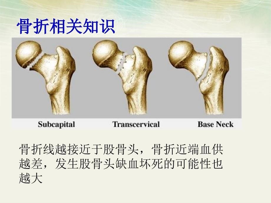 一例股骨颈骨折的康复护理查房_第5页