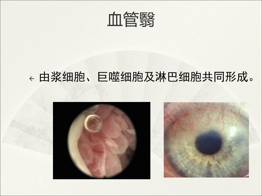 强直性脊柱炎综述_第4页