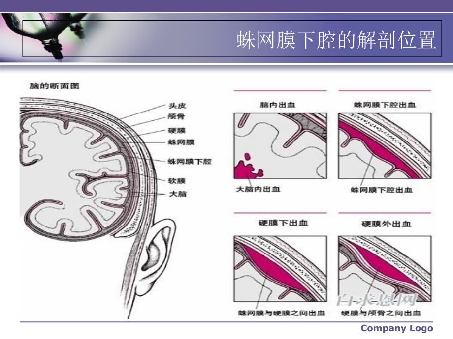 蛛网膜下腔出血_第4页