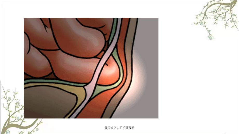 腹外疝病人的护理最新课件_第4页