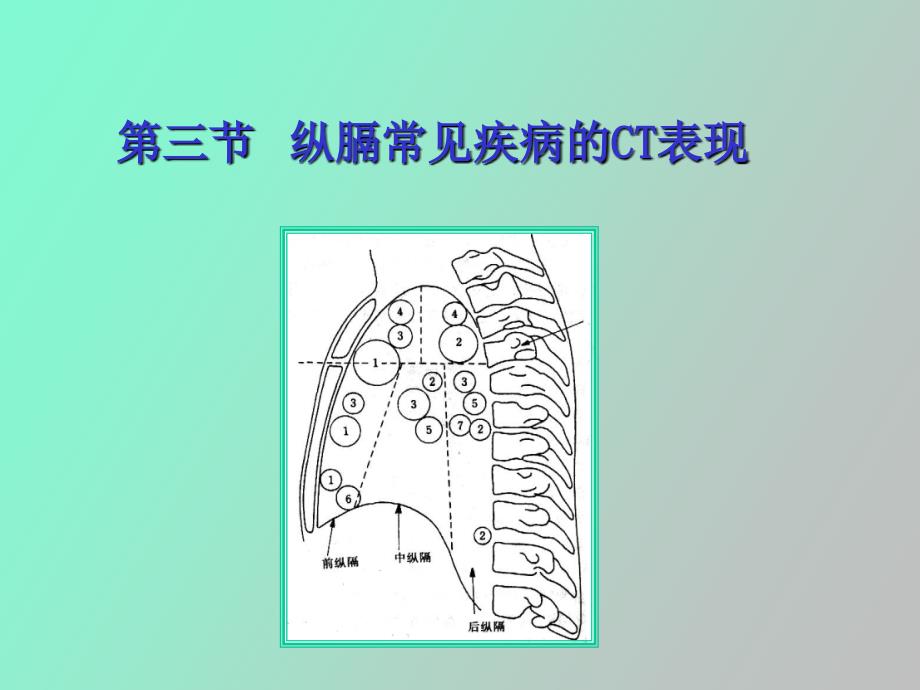 纵膈常见疾病的ct表现_第1页