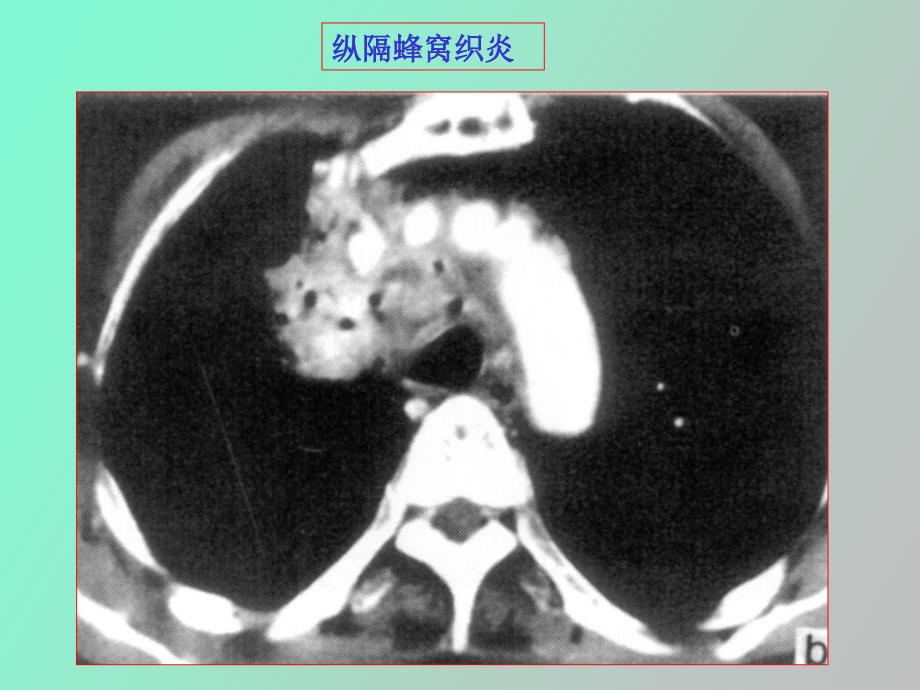 纵膈常见疾病的ct表现_第3页