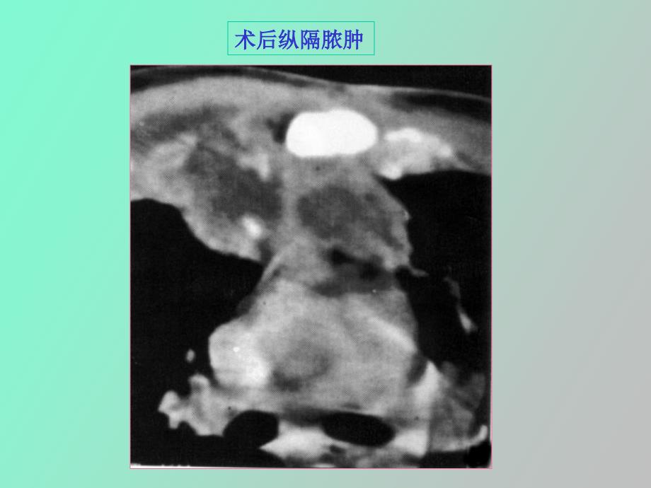 纵膈常见疾病的ct表现_第4页