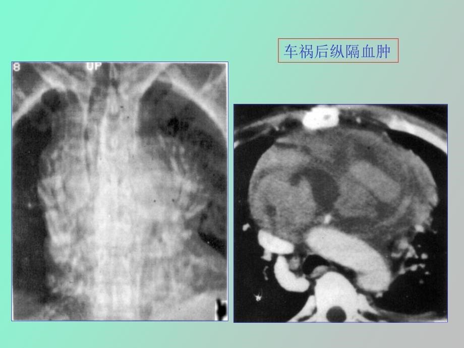 纵膈常见疾病的ct表现_第5页