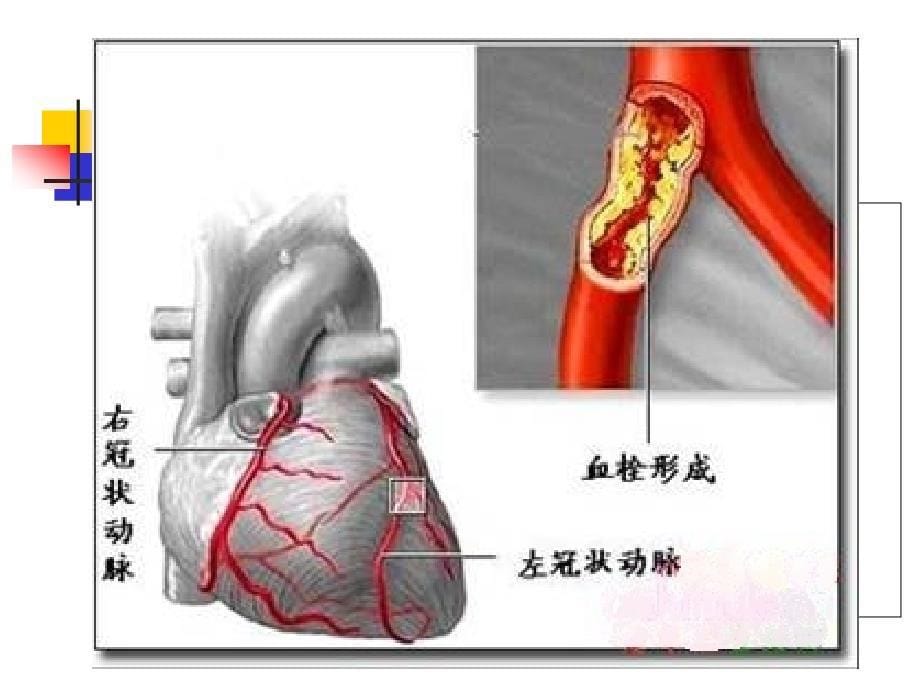 急性心梗患者介入术后护理_第5页