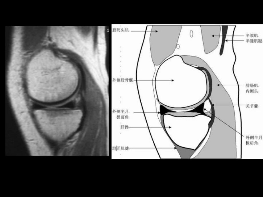 最新半月板和韧带MR诊断ppt课件_第4页