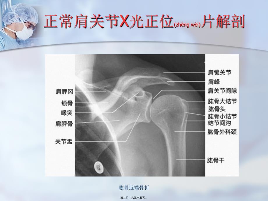 肱骨近端骨折课件_第2页