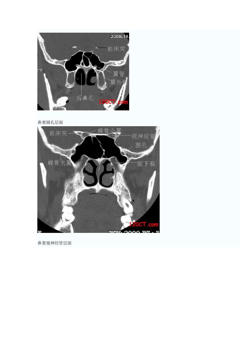 鼻窦冠状HRCT解剖.doc_第2页