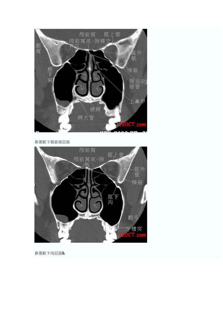 鼻窦冠状HRCT解剖.doc_第4页