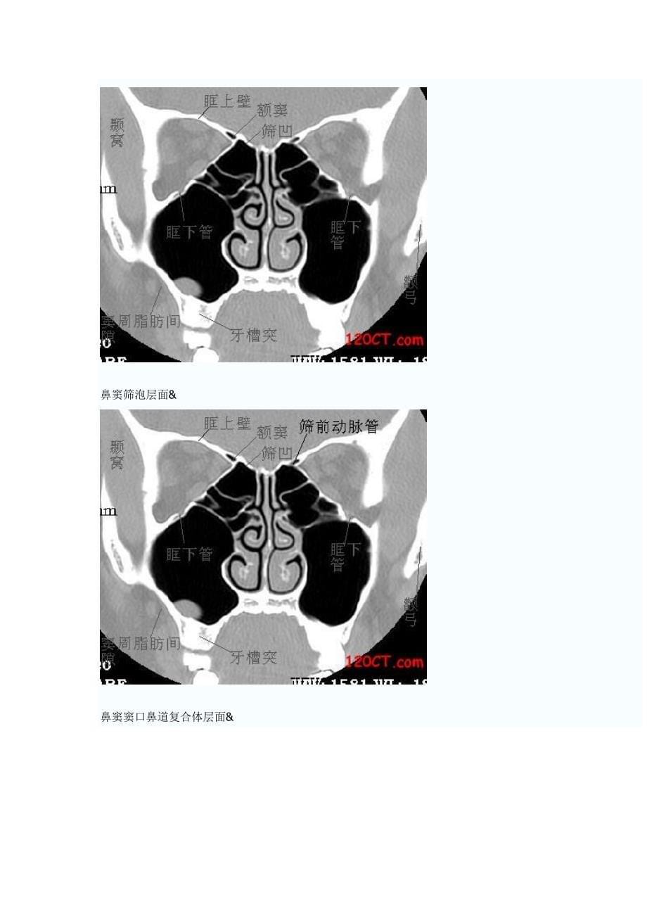 鼻窦冠状HRCT解剖.doc_第5页