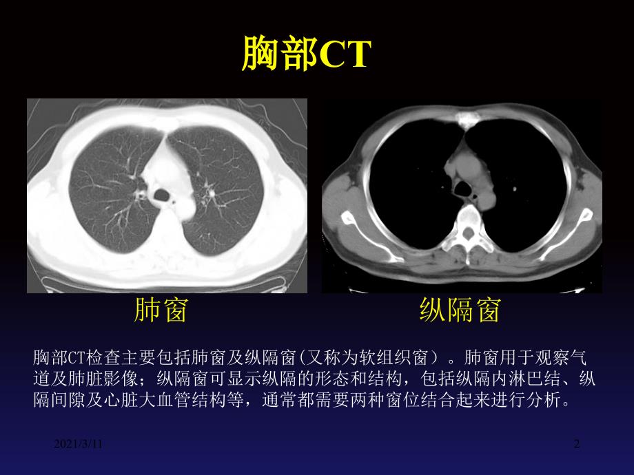 正常胸部CT读片_第2页