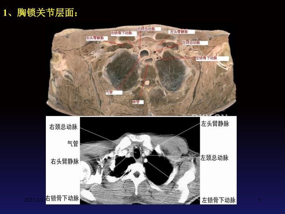 正常胸部CT读片_第5页