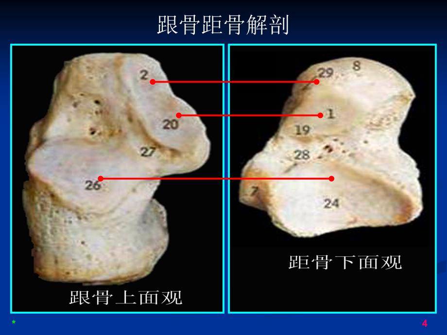 跗骨窦综合征影像诊断_第4页